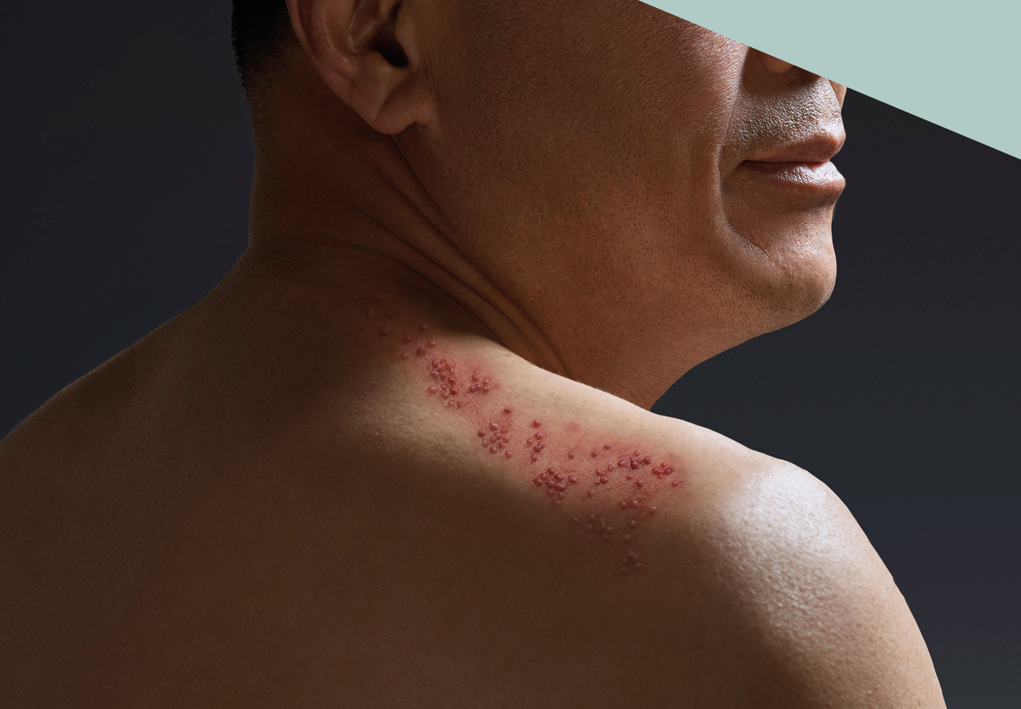man with shingles rash on shoulder