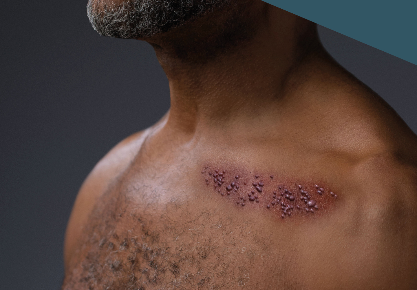 man with shingles rash on chest